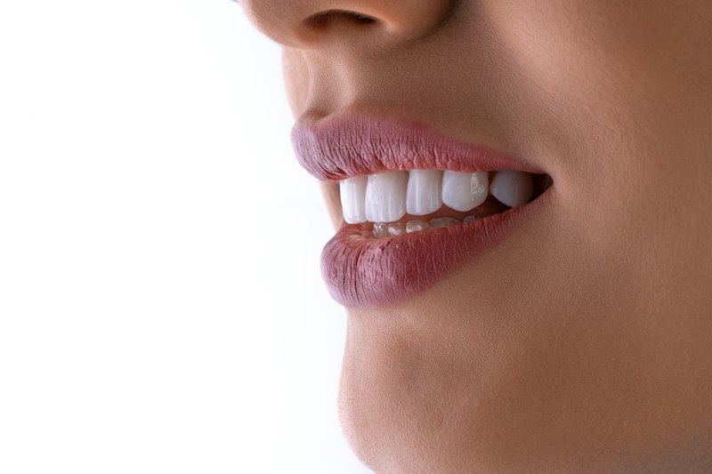 Sorriso com dentes brancos após clareamento