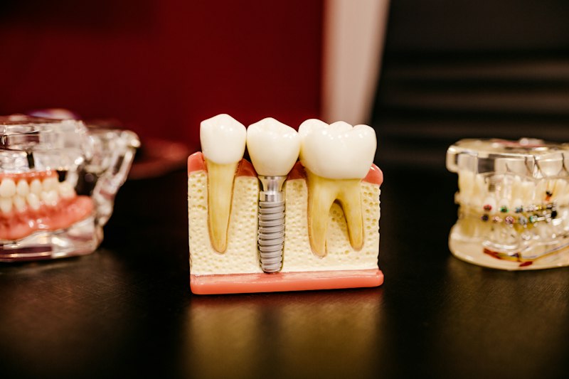 Modelo de implante dentário ao lado de dentes naturais