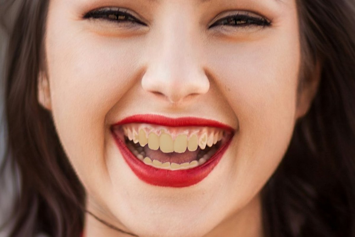 Antes: dentes amarelados