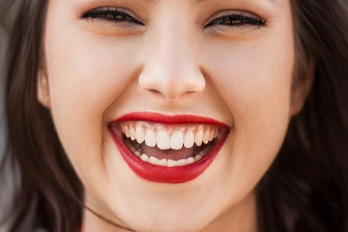 Depois: sorriso com dentes brancos e alinhados